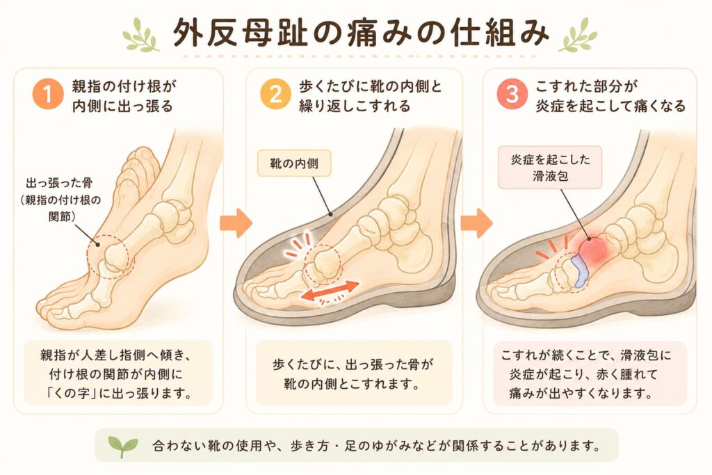 外反母趾の痛みの仕組みを説明した図解。出っ張った骨が靴の内側と繰り返しこすれ、滑液包が炎症を起こす3ステップ